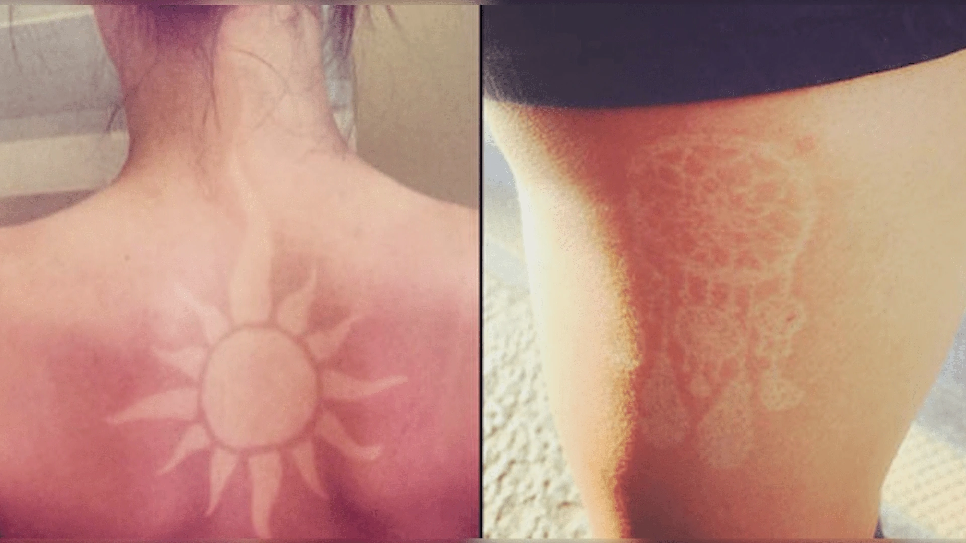 25 Stunning Tattoo Feels Like A Sunburn — Is Normal?